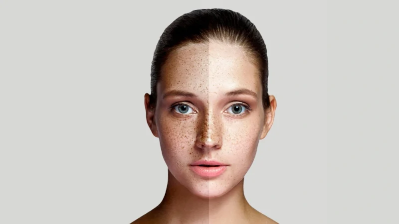 The Role of Skincare in Managing and Treating Melasma